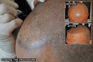 micro hair tattoo procedure 550x365 300x199 Нарисованные волосы как средство против облысения